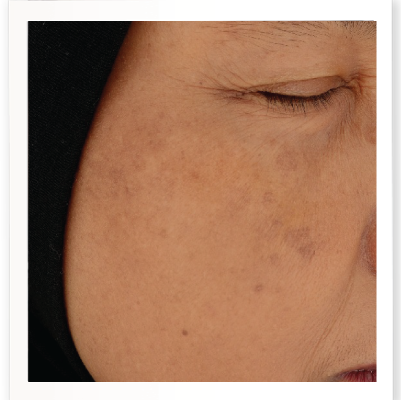 After Skin Booster