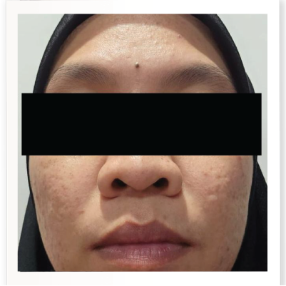 After Skin Booster