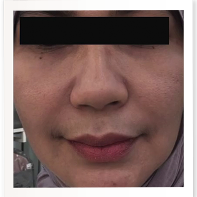 After Skin Booster