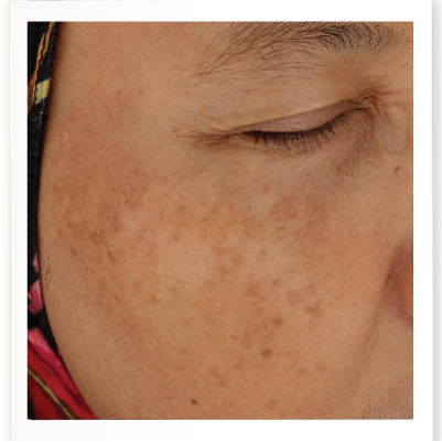 Before Skin Booster