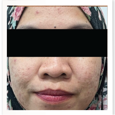 Before Skin Booster