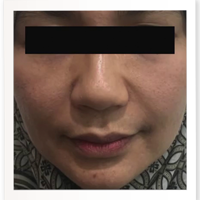 Before Skin Booster
